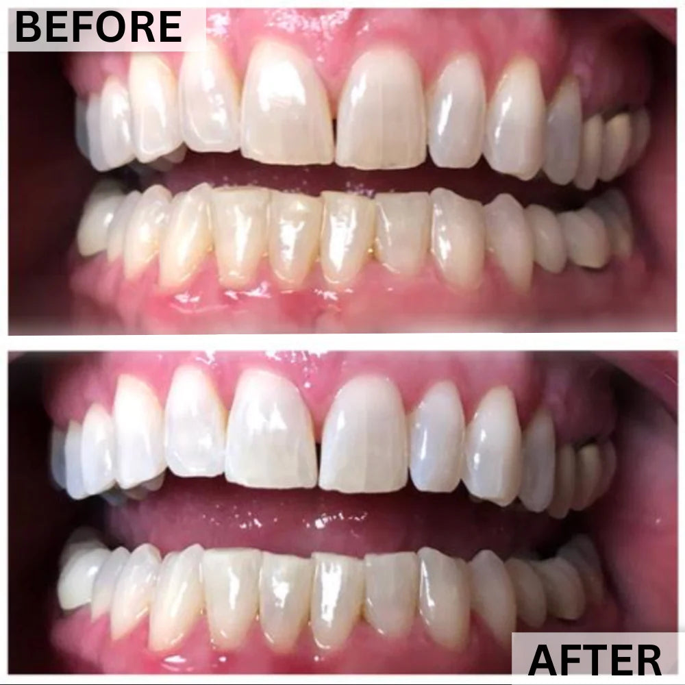 GLOwhite Teeth Whitening Gel