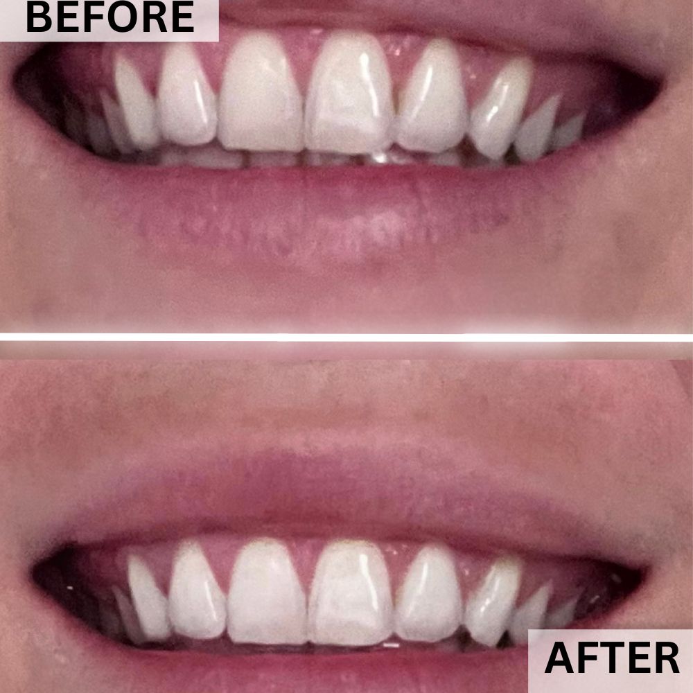 PlasmaGLO™ LED Lip & Mouth Device
