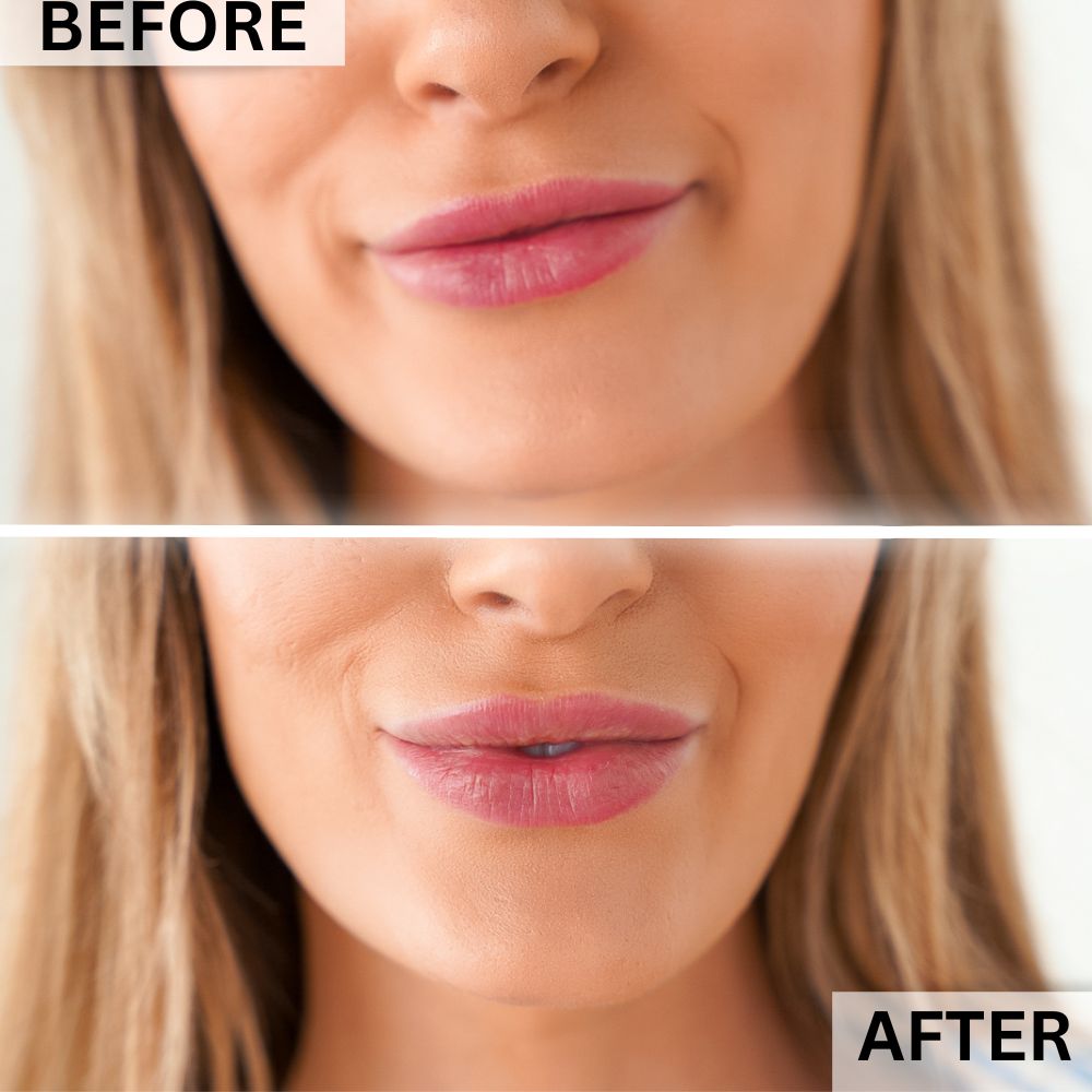 PlasmaGLO™ LED Lip & Mouth Device