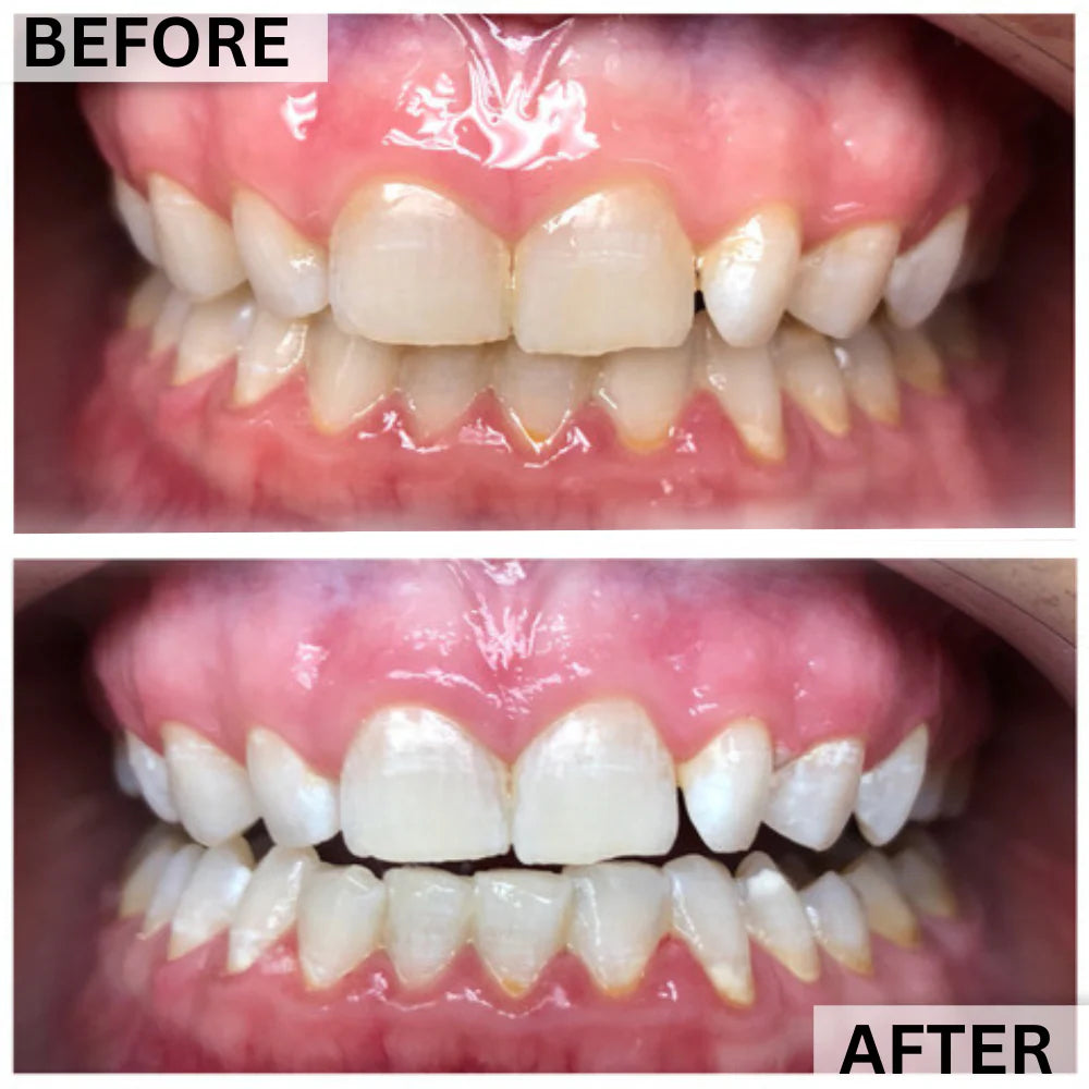 GLOwhite Teeth Whitening Gel