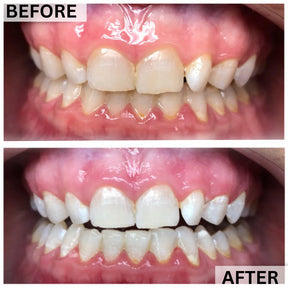 GLOwhite Teeth Whitening Gel