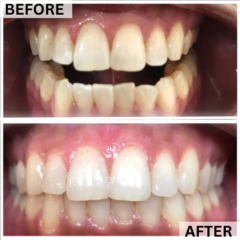GLOwhite Teeth Whitening Gel