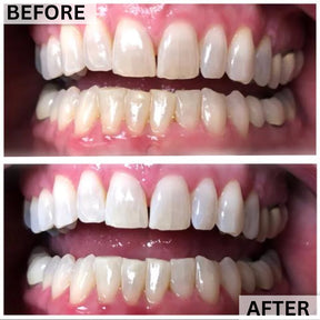 GLOwhite Teeth Whitening Gel