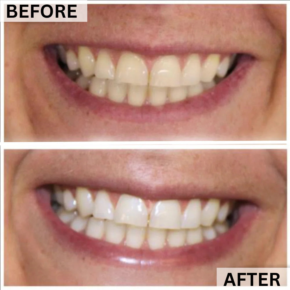 GLOwhite Teeth Whitening Gel