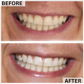 GLOwhite Teeth Whitening Gel